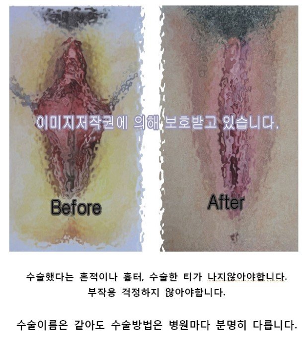 질염치료로 소음순수술 많이 받아 : 네이버 포스트