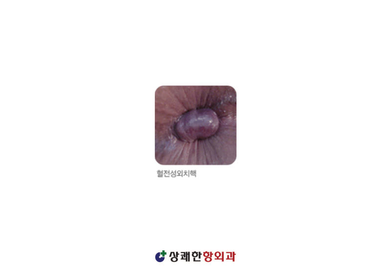 혈전성 외치핵 있을 때, 수술 치료만이 답일까? : 네이버 블로그