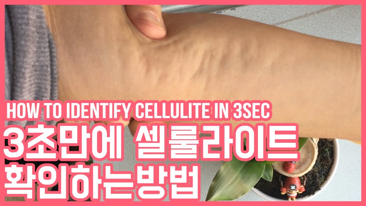 3초만에 내 몸 속 셀룰라이트 확인하는 방법(How To Identify Cellulite In 3Sec) - Youtube