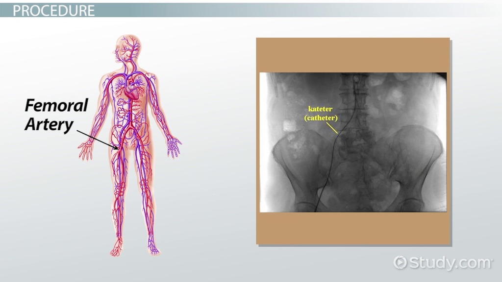 Angiogram | Definition, Complications & Types - Video & Lesson Transcript |  Study.Com