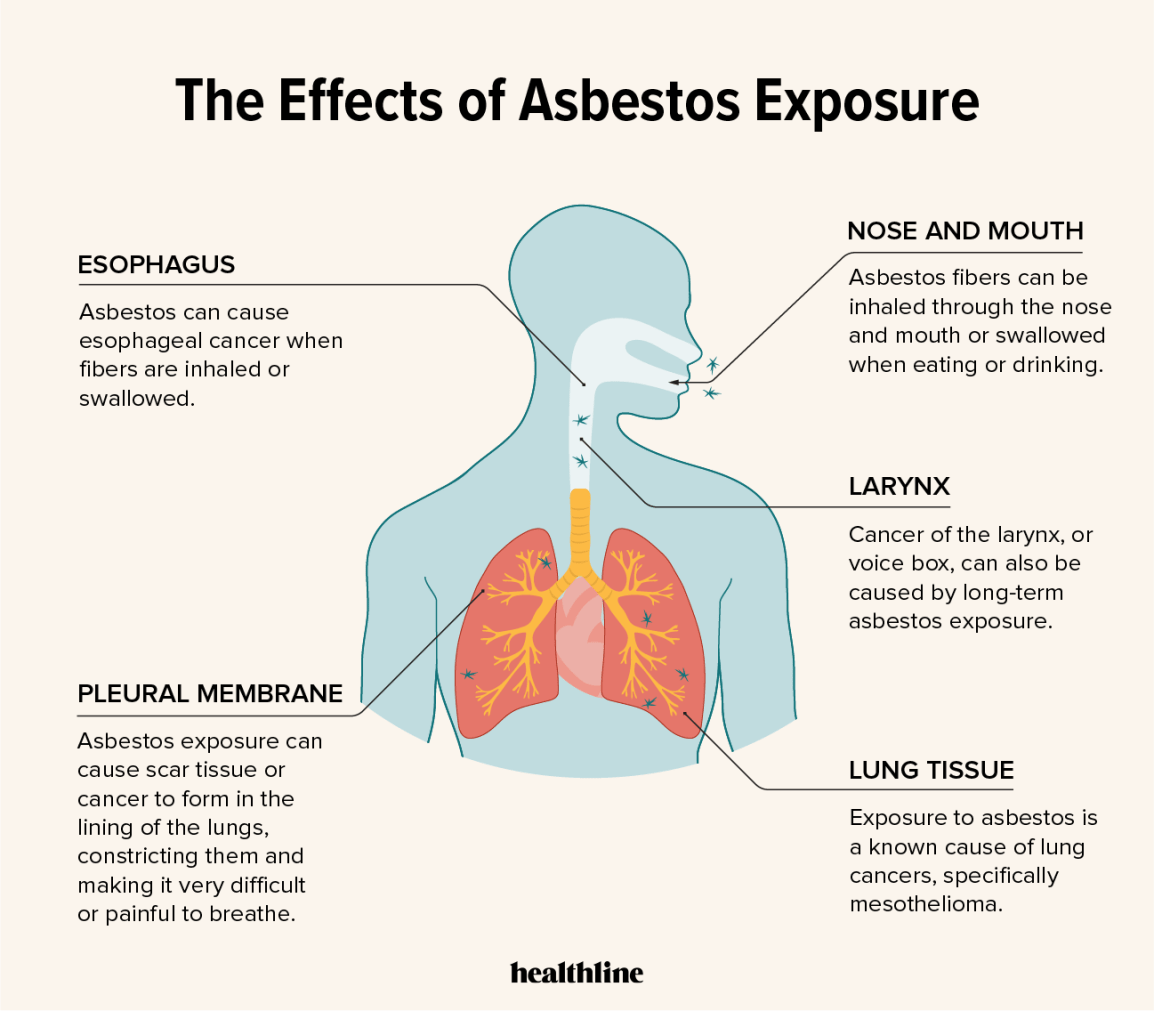 What'S The Link Between Asbestos And Lung Cancer?