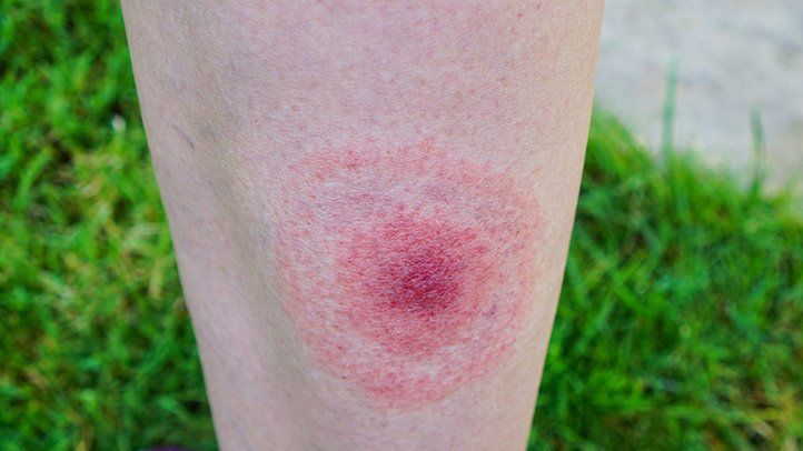 Bitten By A Tick? How To Know