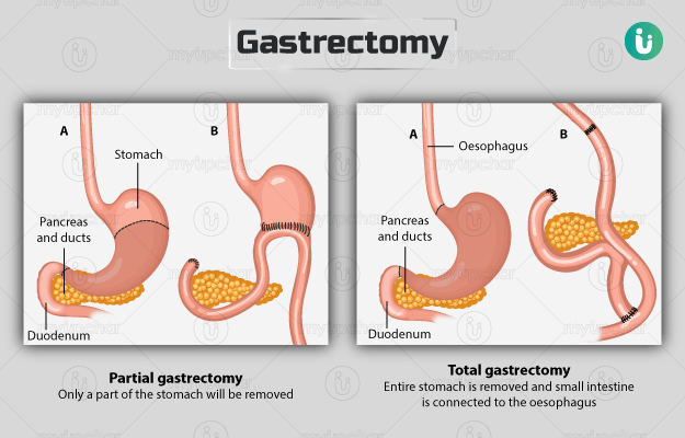 Gastrectomy: Procedure, Purpose, Results, Cost, Price