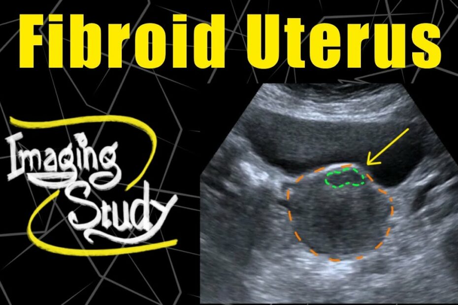 Fibroid Uterus || Ultrasound || Case 120 - Youtube