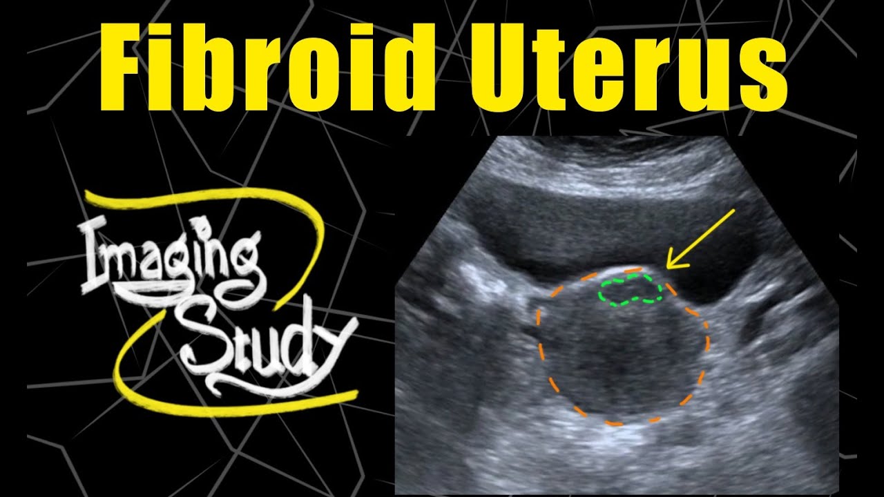 Fibroid Uterus || Ultrasound || Case 120 - Youtube