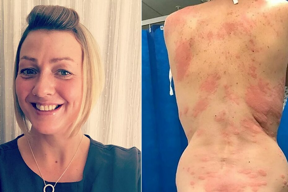 Woman Claims Allergic Reaction To Vape Caused Painful Rash, Required  Hospital Visit | Fox News