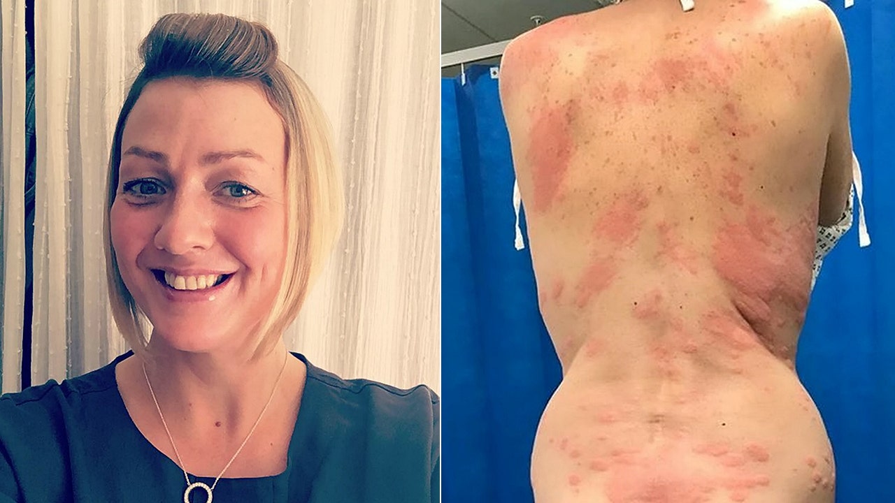 Woman Claims Allergic Reaction To Vape Caused Painful Rash, Required  Hospital Visit | Fox News