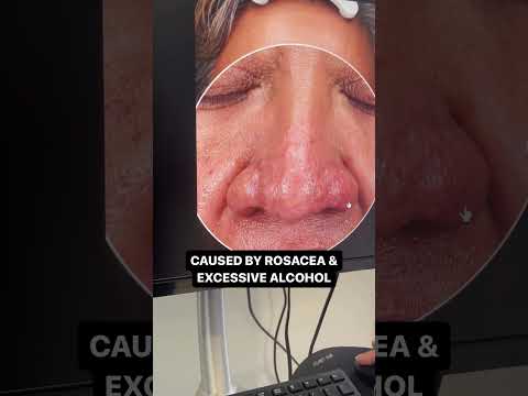 How I Treat Rhinophyma 🔥 (Reshaping Enlarged/Deformed Nose With a LASER)