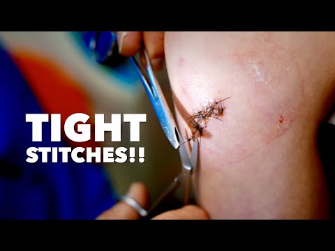 VERY DIFFICULT STITCHES REMOVAL! (Brave and Adorable Little Girl) | Dr. Paul