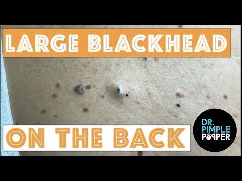 Large Blackheads on the Back